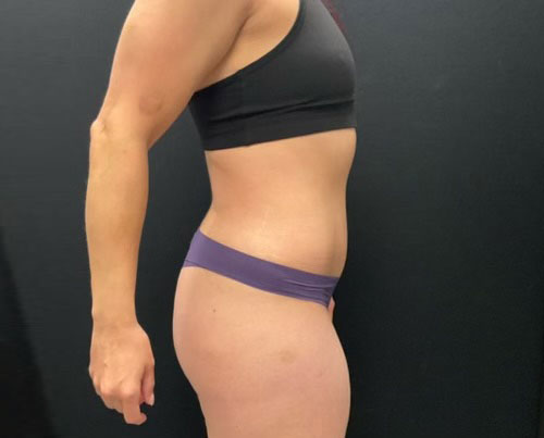 36 year old woman shown 4 months after abdominoplasty with 360 degree liposuction