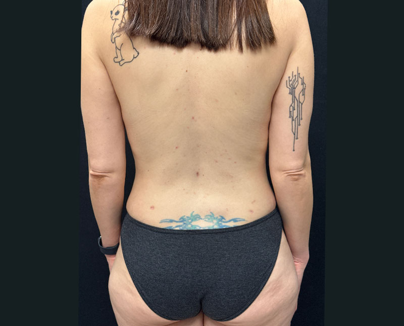 40-year-old mother shown three months after full abdominal plasty with 360° liposuction and bilateral mastopexy with auto augmentation.
