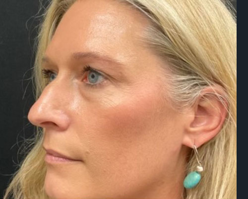 37-year-old female 6 weeks after closed rhinoplasty