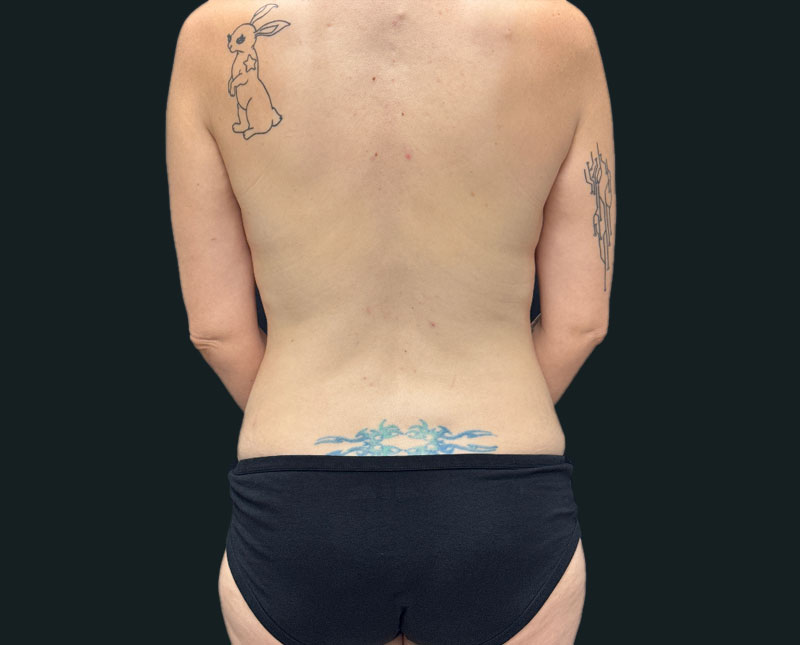 40-year-old mother shown three months after full abdominal plasty with 360° liposuction and bilateral mastopexy with auto augmentation.