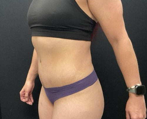 36 year old woman shown 4 months after abdominoplasty with 360 degree liposuction