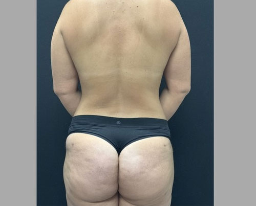 32 year old female 3 months after a “mommy makeover”. Her surgery consisted of full abdominoplasty, 360 degree liposuction, fat grafting to hip dips, bilateral subfascial breast augmentation with low profile implants and mastopexy.