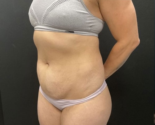 36 year old woman shown 4 months after abdominoplasty with 360 degree liposuction