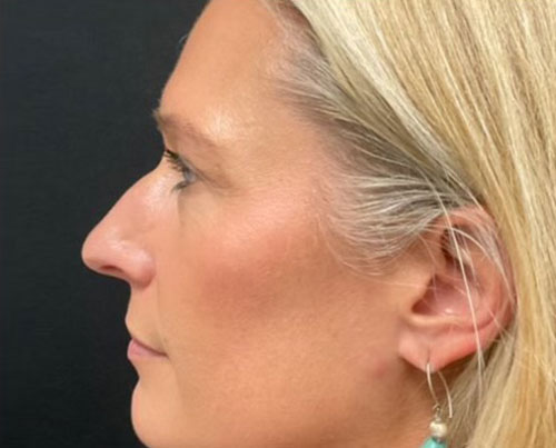 37-year-old female 6 weeks after closed rhinoplasty