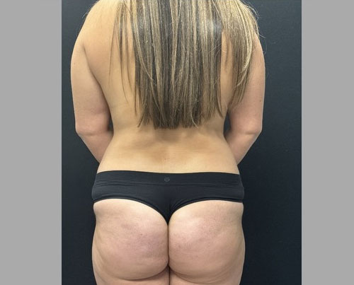 32 year old female 3 months after a “mommy makeover”. Her surgery consisted of full abdominoplasty, 360 degree liposuction, fat grafting to hip dips, bilateral subfascial breast augmentation with low profile implants and mastopexy.