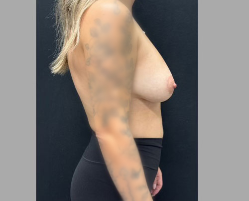 34-year-old patient 3 months after mastopexy and subfascial augmentation with low profile Sientra implants