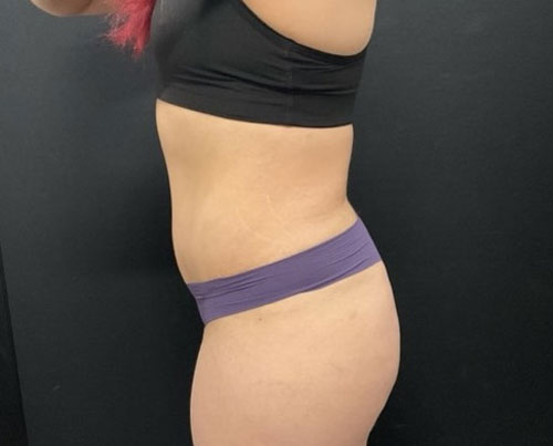 36 year old woman shown 4 months after abdominoplasty with 360 degree liposuction