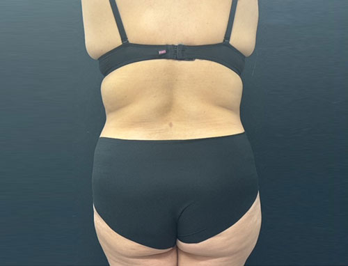 Woman in her 30s shown 4 months after full extended abdominoplasty and 360 degree liposuction