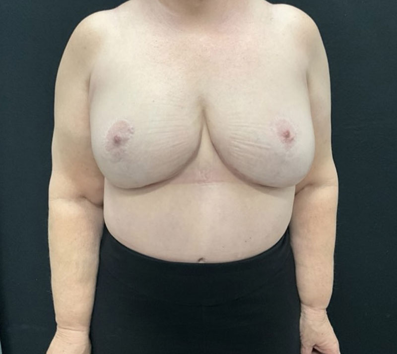 65 year old woman shown about 1 year after a breast lift with internal bra, full abdominoplasty with 360 degree liposuction