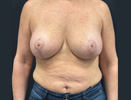54 year old 3 months after bilateral breast implant exchange to 355 MP + implants, vertical mastopexy, capsulorrhaphy, axillary liposuction and placement of Durasorb (internal bra)