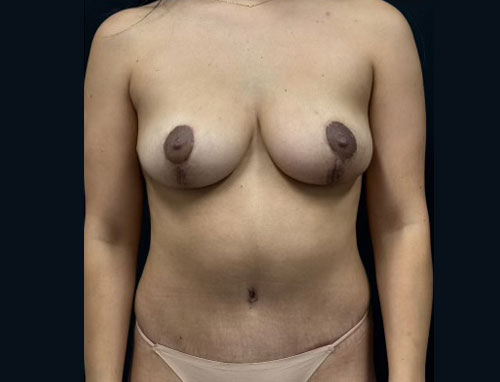 32 year old woman shown 4 months after full abdominoplasty with liposuction of the flanks and upper abdomen and bilateral mastopexy