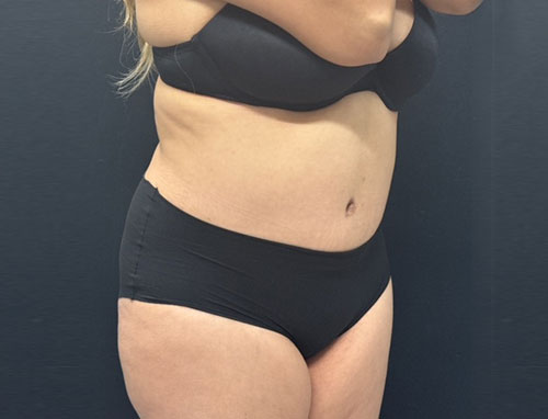 Woman in her 30s shown 4 months after full extended abdominoplasty and 360 degree liposuction