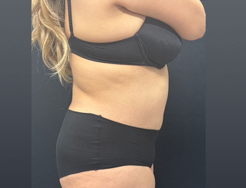 Woman in her 30s shown 4 months after full extended abdominoplasty and 360 degree liposuction