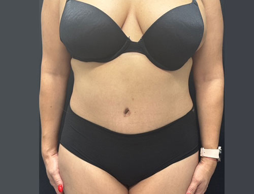 Woman in her 30s shown 4 months after full extended abdominoplasty and 360 degree liposuction