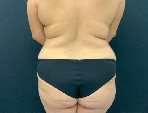 Woman in her 30s shown 4 months after full extended abdominoplasty and 360 degree liposuction