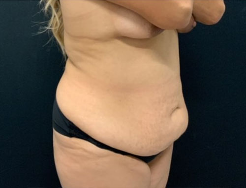 Woman in her 30s shown 4 months after full extended abdominoplasty and 360 degree liposuction