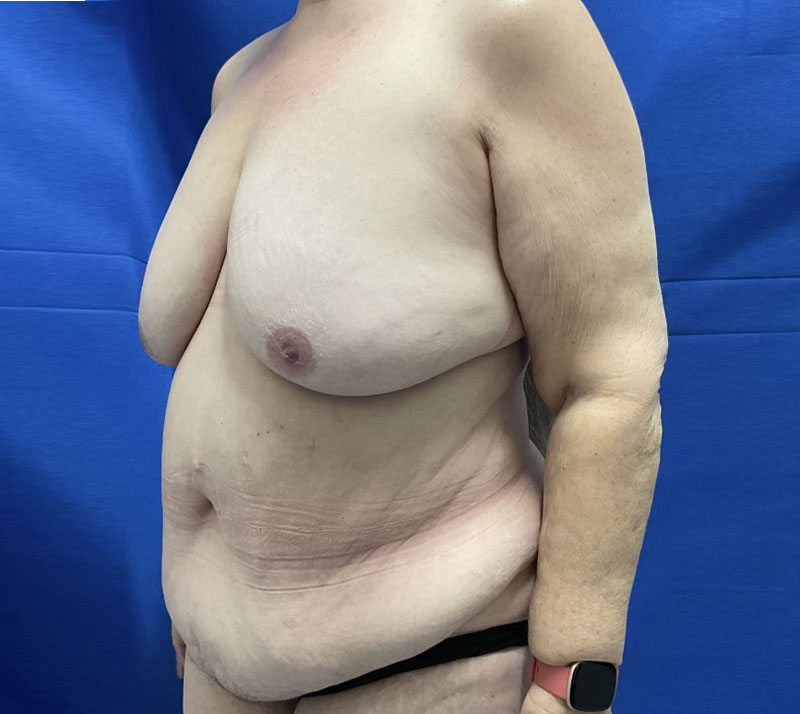 65 year old woman shown about 1 year after a breast lift with internal bra, full abdominoplasty with 360 degree liposuction