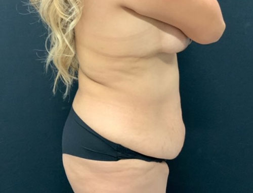 Woman in her 30s shown 4 months after full extended abdominoplasty and 360 degree liposuction