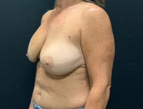 54 year old 3 months after bilateral breast implant exchange to 355 MP + implants, vertical mastopexy, capsulorrhaphy, axillary liposuction and placement of Durasorb (internal bra)