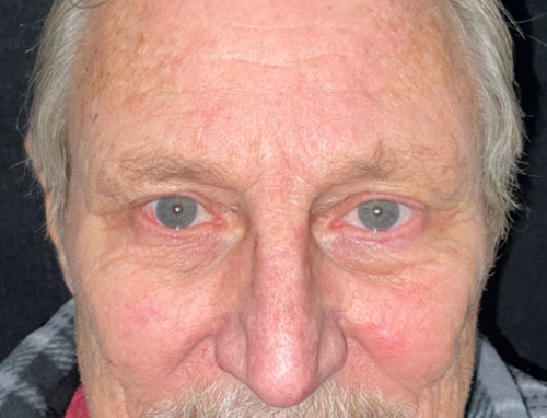 Upper eyelid lift before and after patient front view