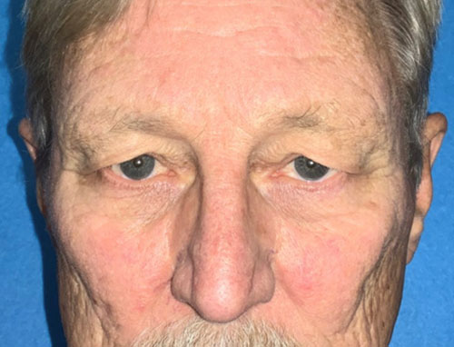 Upper eyelid lift before and after patient front view