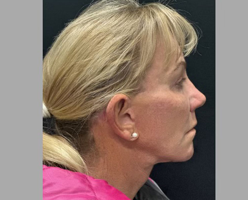 69-year-old female 3 months after full facelift, necklift, facial fat grafting, upper blepharoplasties and brow lift