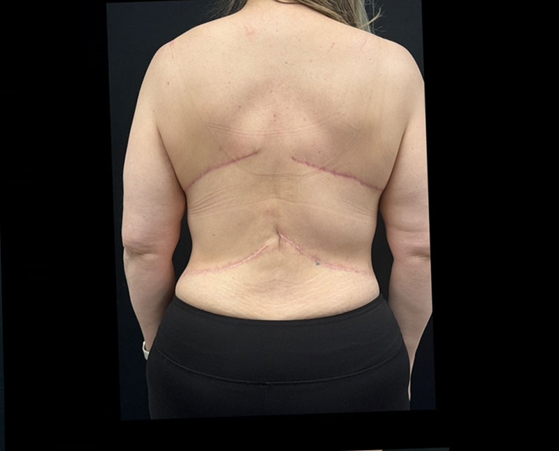 A woman in her 40s shown 5 months after upper and lower body lift