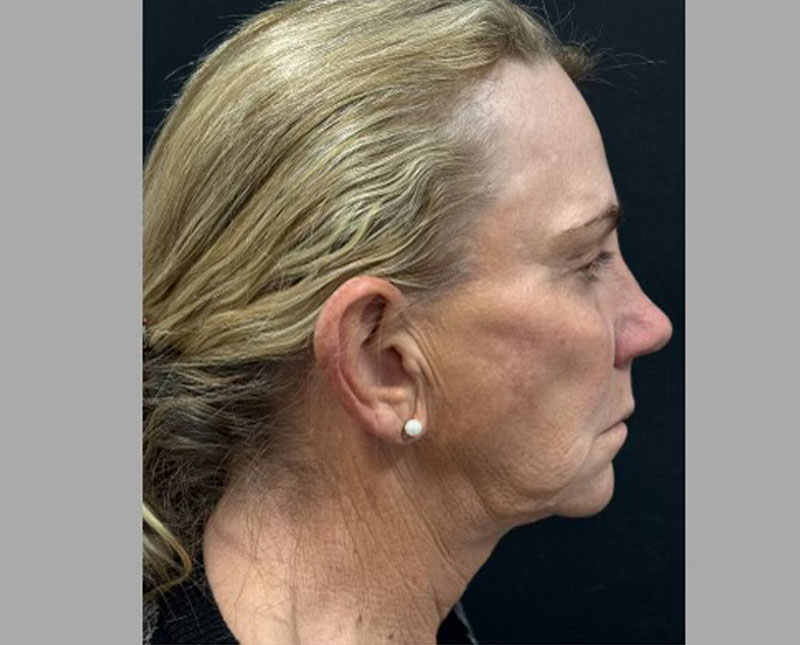 69-year-old female 3 months after full facelift, necklift, facial fat grafting, upper blepharoplasties and brow lift