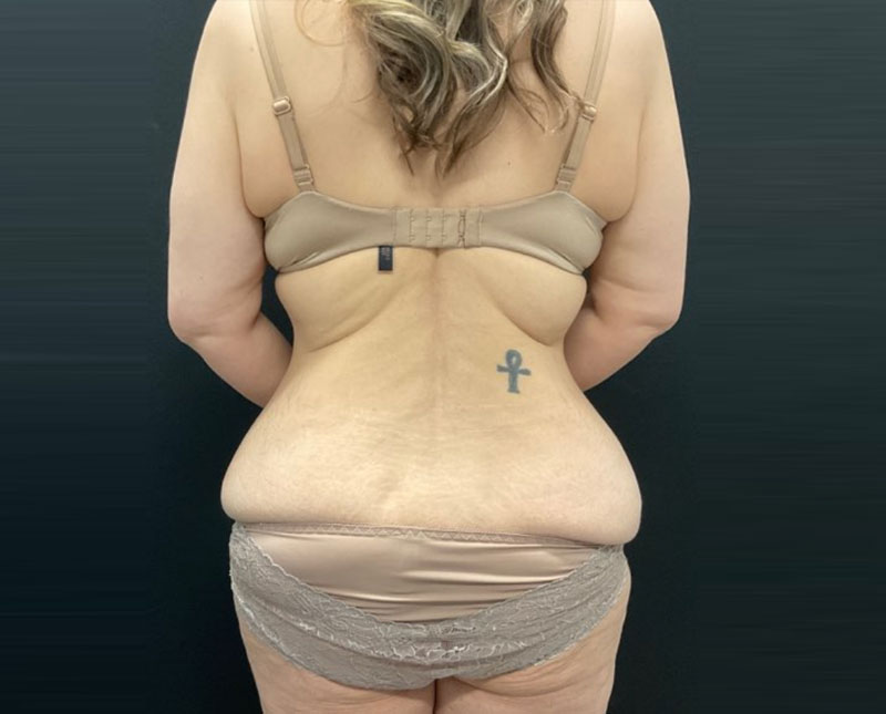 A woman in her 40s shown 5 months after upper and lower body lift