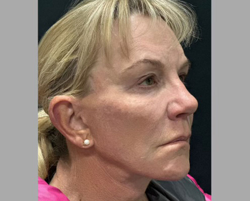 69-year-old female 3 months after full facelift, necklift, facial fat grafting, upper blepharoplasties and brow lift