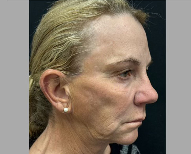 69-year-old female 3 months after full facelift, necklift, facial fat grafting, upper blepharoplasties and brow lift