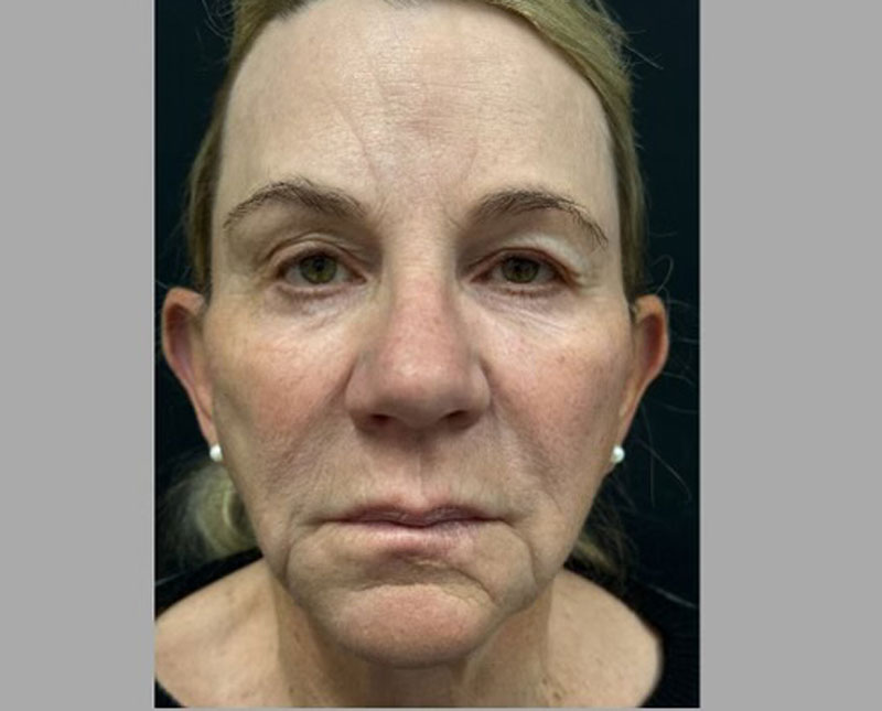 69-year-old female 3 months after full facelift, necklift, facial fat grafting, upper blepharoplasties and brow lift