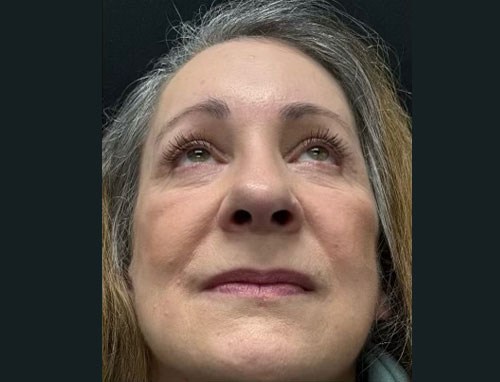 60 year old female 4 months after revision of her rhinoplasty with ear cartilage grafts. Functional rhinoplasty was performed to improve her breathing and restructure her nasal shape