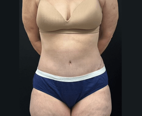 59-year-old female shown 3.5 months after full abdominoplasty with flankplasty and liposuction