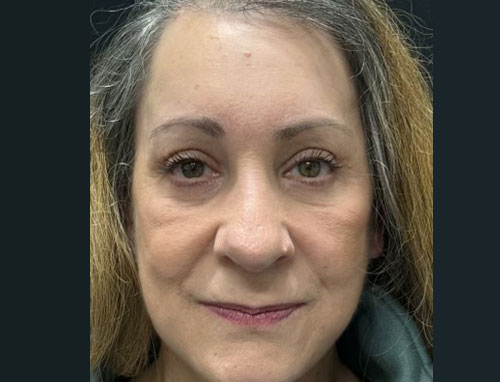 60 year old female 4 months after revision of her rhinoplasty with ear cartilage grafts. Functional rhinoplasty was performed to improve her breathing and restructure her nasal shape