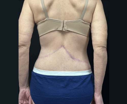 59-year-old female shown 3.5 months after full abdominoplasty with flankplasty and liposuction