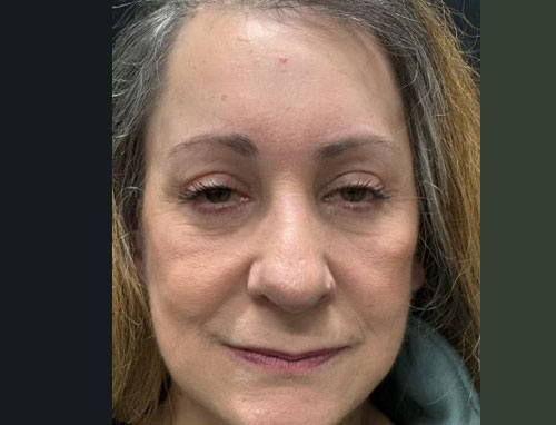 60 year old female 4 months after revision of her rhinoplasty with ear cartilage grafts. Functional rhinoplasty was performed to improve her breathing and restructure her nasal shape