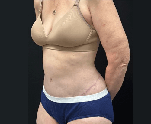 59-year-old female shown 3.5 months after full abdominoplasty with flankplasty and liposuction