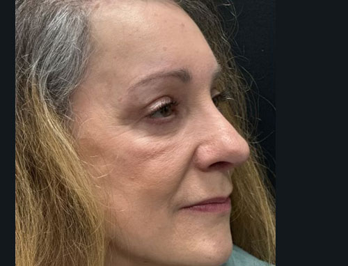 60 year old female 4 months after revision of her rhinoplasty with ear cartilage grafts. Functional rhinoplasty was performed to improve her breathing and restructure her nasal shape