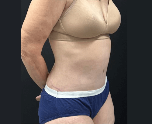 59-year-old female shown 3.5 months after full abdominoplasty with flankplasty and liposuction