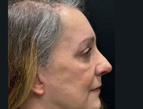 60 year old female 4 months after revision of her rhinoplasty with ear cartilage grafts. Functional rhinoplasty was performed to improve her breathing and restructure her nasal shape