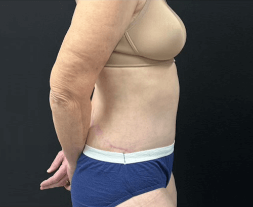 59-year-old female shown 3.5 months after full abdominoplasty with flankplasty and liposuction