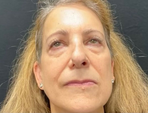 60 year old female 4 months after revision of her rhinoplasty with ear cartilage grafts. Functional rhinoplasty was performed to improve her breathing and restructure her nasal shape