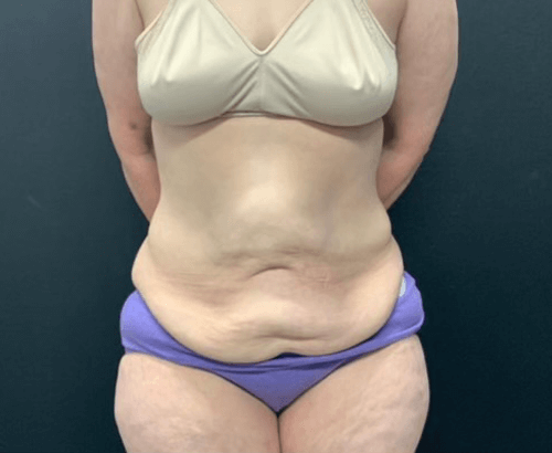 59-year-old female shown 3.5 months after full abdominoplasty with flankplasty and liposuction