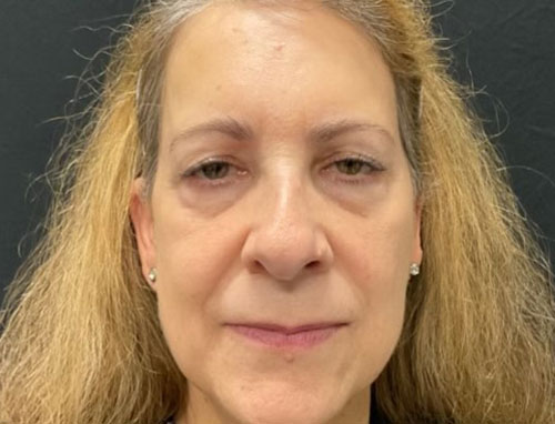 60 year old female 4 months after revision of her rhinoplasty with ear cartilage grafts. Functional rhinoplasty was performed to improve her breathing and restructure her nasal shape