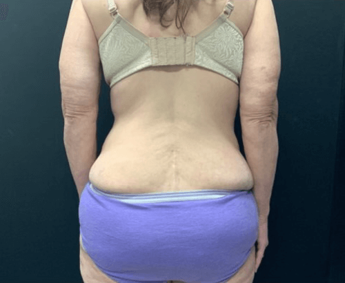 59-year-old female shown 3.5 months after full abdominoplasty with flankplasty and liposuction