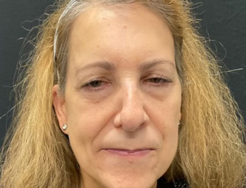 60 year old female 4 months after revision of her rhinoplasty with ear cartilage grafts. Functional rhinoplasty was performed to improve her breathing and restructure her nasal shape