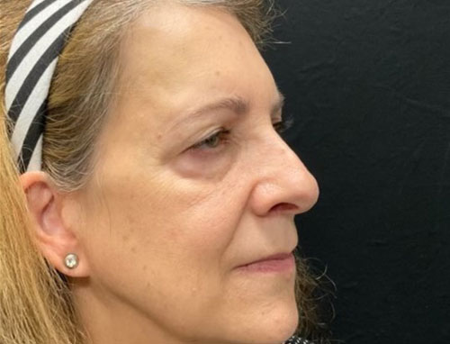 60 year old female 4 months after revision of her rhinoplasty with ear cartilage grafts. Functional rhinoplasty was performed to improve her breathing and restructure her nasal shape