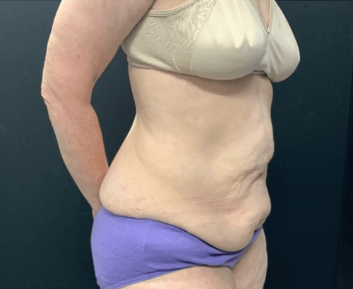 59-year-old female shown 3.5 months after full abdominoplasty with flankplasty and liposuction