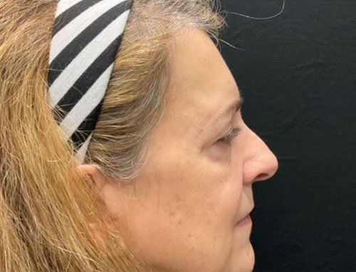 60 year old female 4 months after revision of her rhinoplasty with ear cartilage grafts. Functional rhinoplasty was performed to improve her breathing and restructure her nasal shape